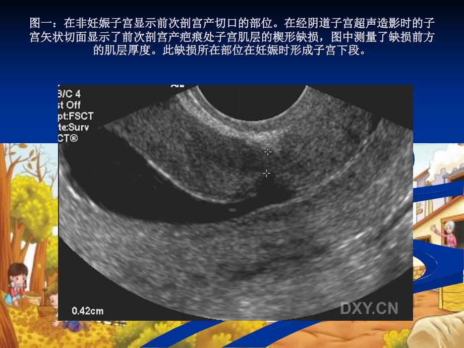 专业培训资料子宫下段超声检查_第3页