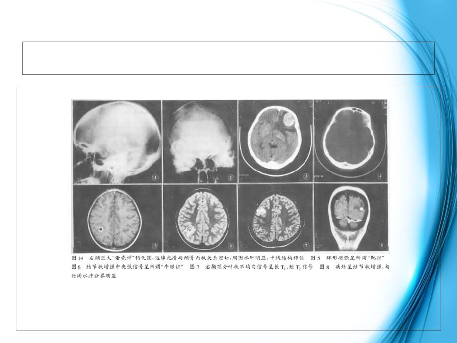 颅内结核mri影像表现+鉴别诊断_2.ppt_第2页