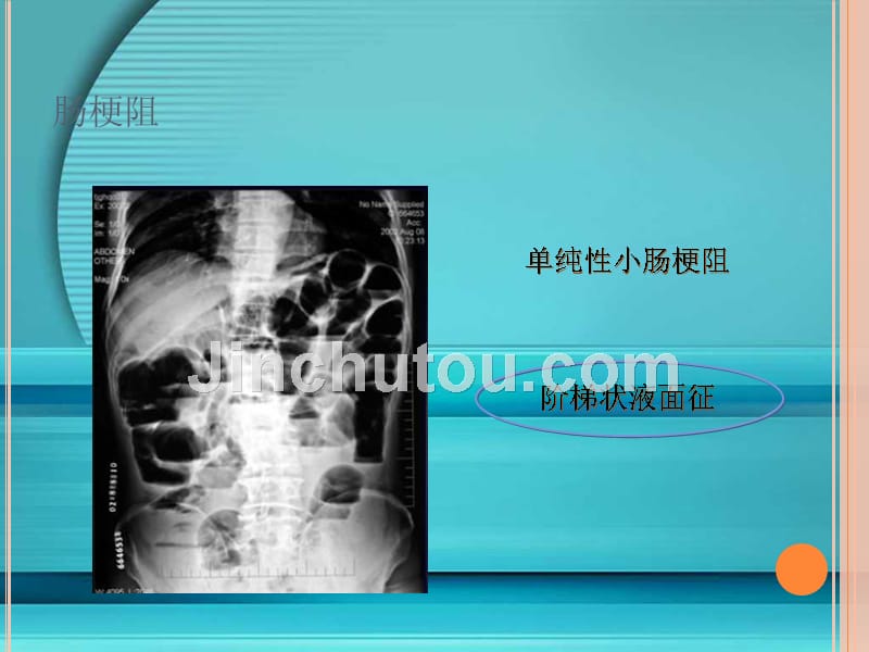 急性腹痛影像学改变讲义_第5页