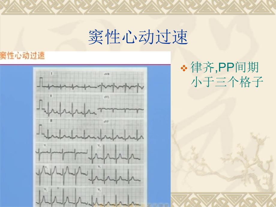 临床实践技能考试-心电图.ppt_第3页