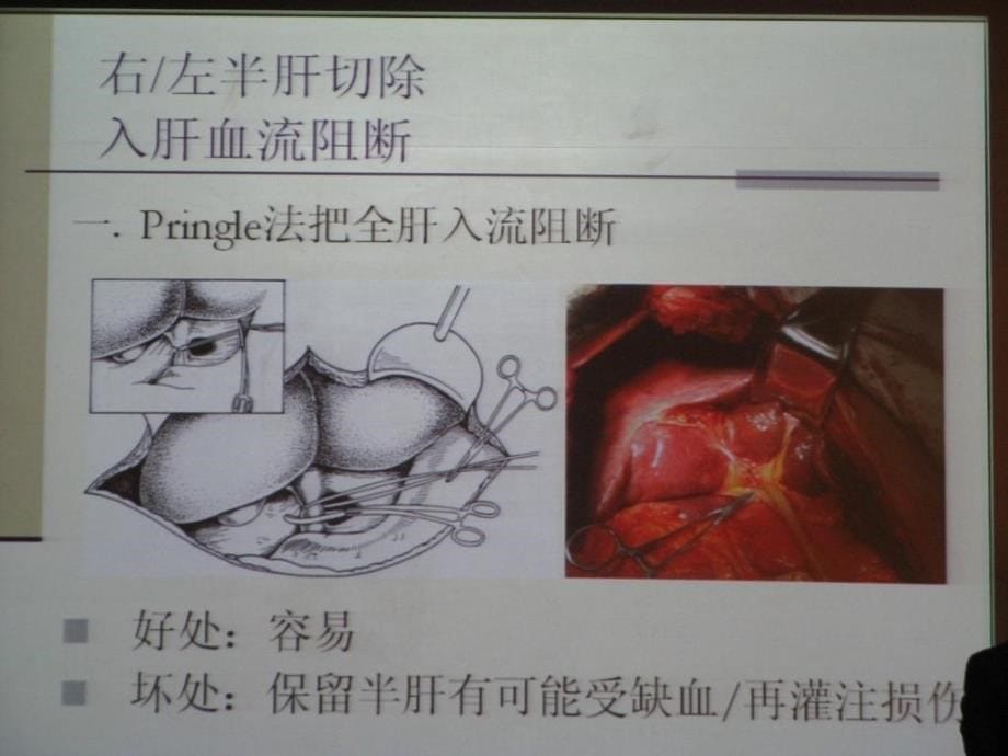 肝切除中出入血流阻断技术_第5页
