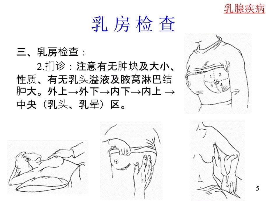 乳腺疾病(课件)概要_第5页