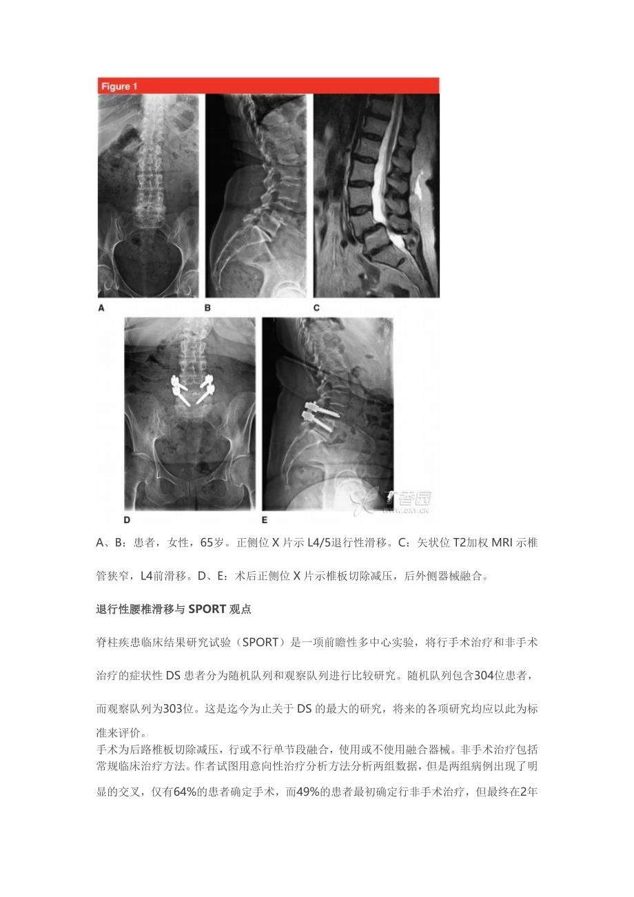 退行性腰椎滑移的手术治疗-来自JAAOS_第3页