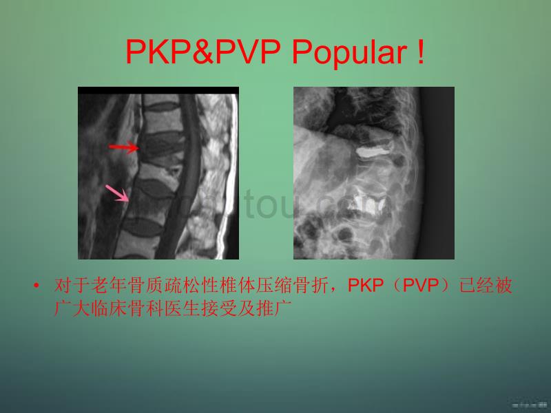 老年重度骨质疏松性腰椎管狭窄症手术有效治疗_第3页