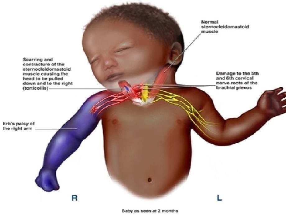 新生儿臂丛神经损伤资料_第5页