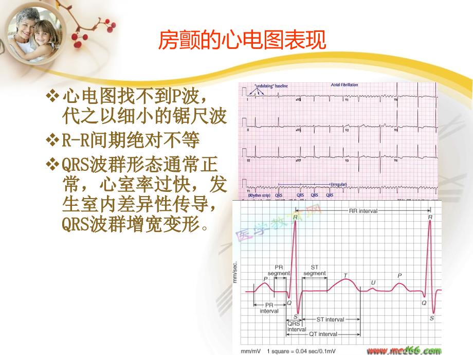 心房颤动行射频消融术8_第3页