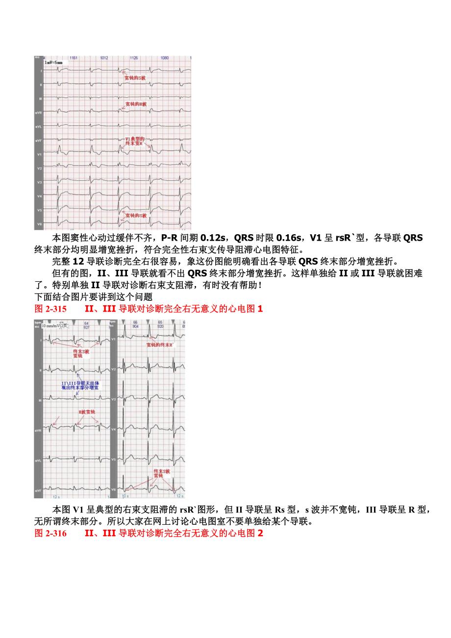 另类心电图讲义-10--心脏传导阻滞-室内传导阻滞_第2页