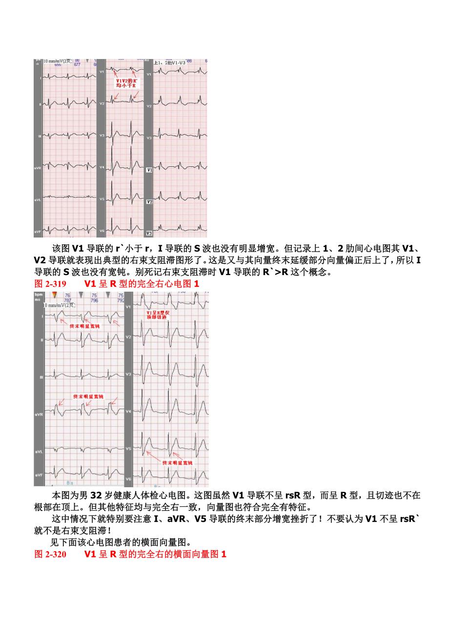 另类心电图讲义-10--心脏传导阻滞-室内传导阻滞_第4页