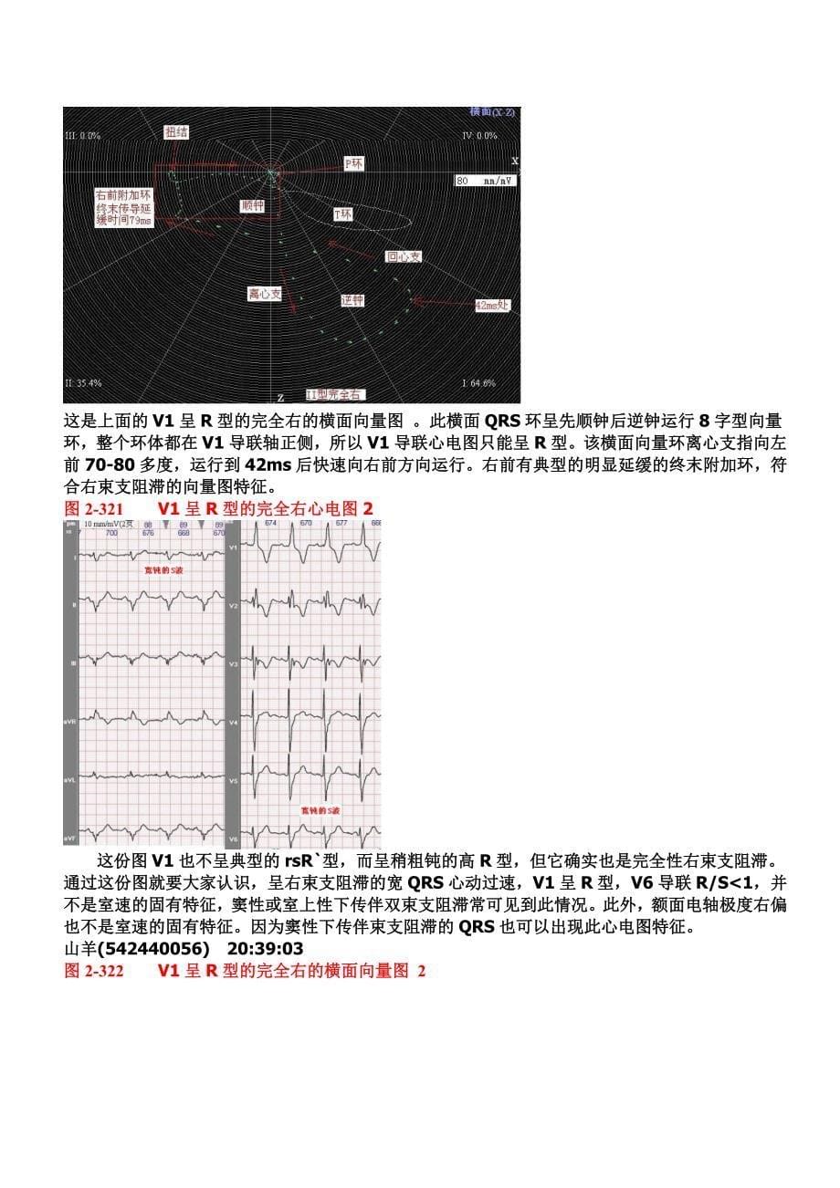 另类心电图讲义-10--心脏传导阻滞-室内传导阻滞_第5页