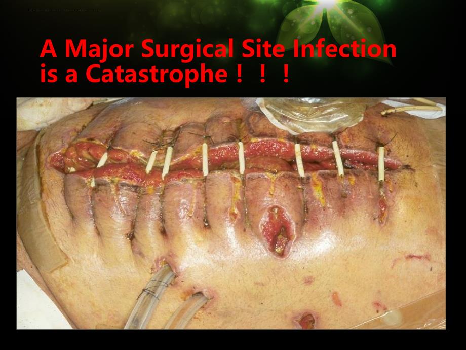 外科手术部位感染的预防与控制.ppt_第3页