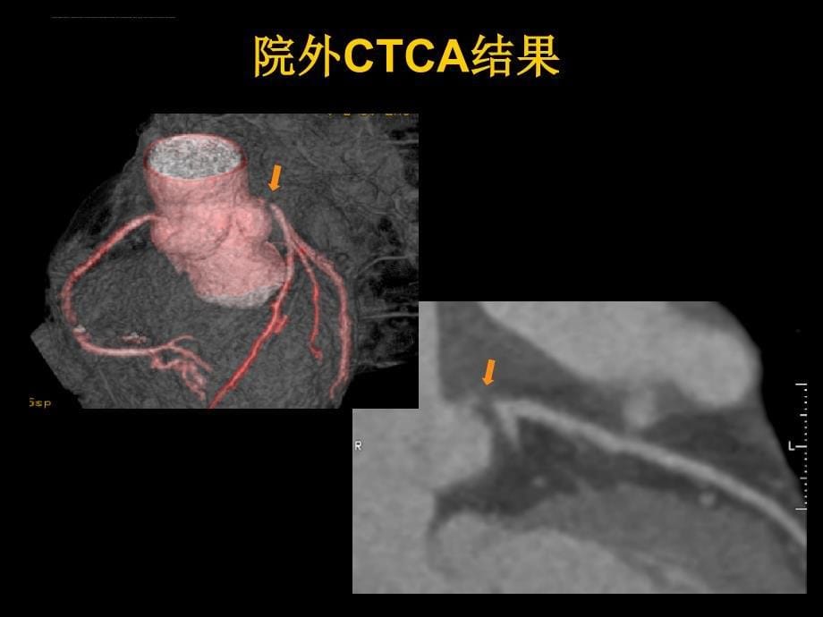 大动脉炎合并冠状动脉狭窄.ppt_第5页