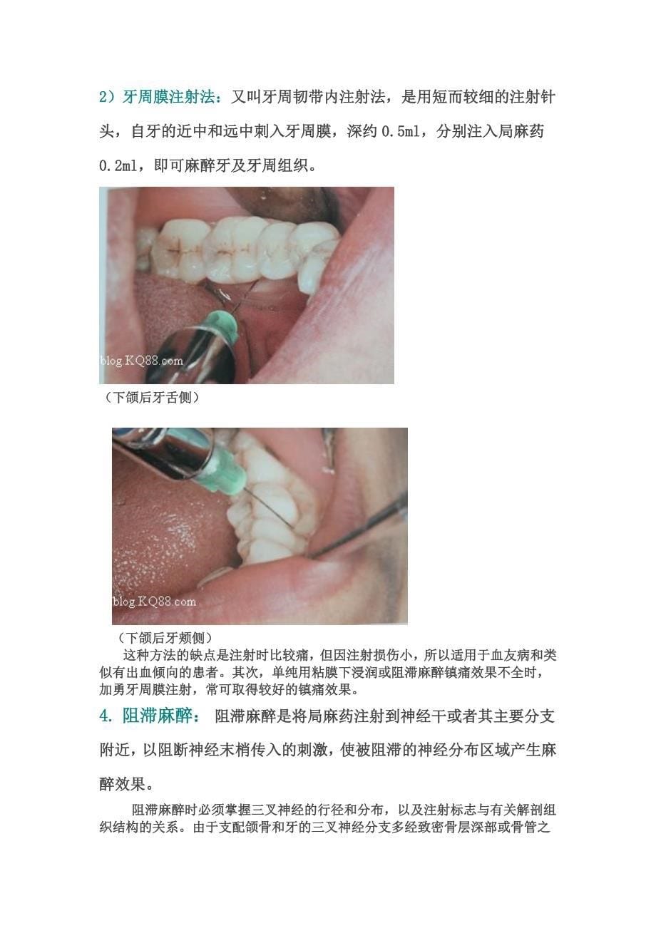 规范化操作之口腔常用几种麻醉图汇编_第5页