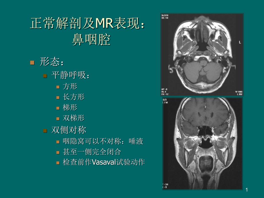 鼻咽癌mr诊断2018资料_第1页