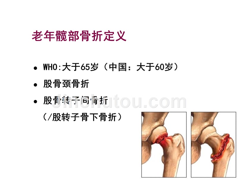 裴福兴老年髋部骨折围手术期的评估与处理_第2页