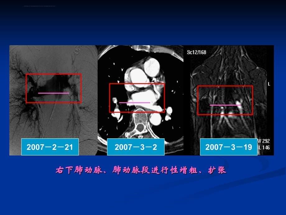 肺栓塞影像学诊断.ppt_第5页