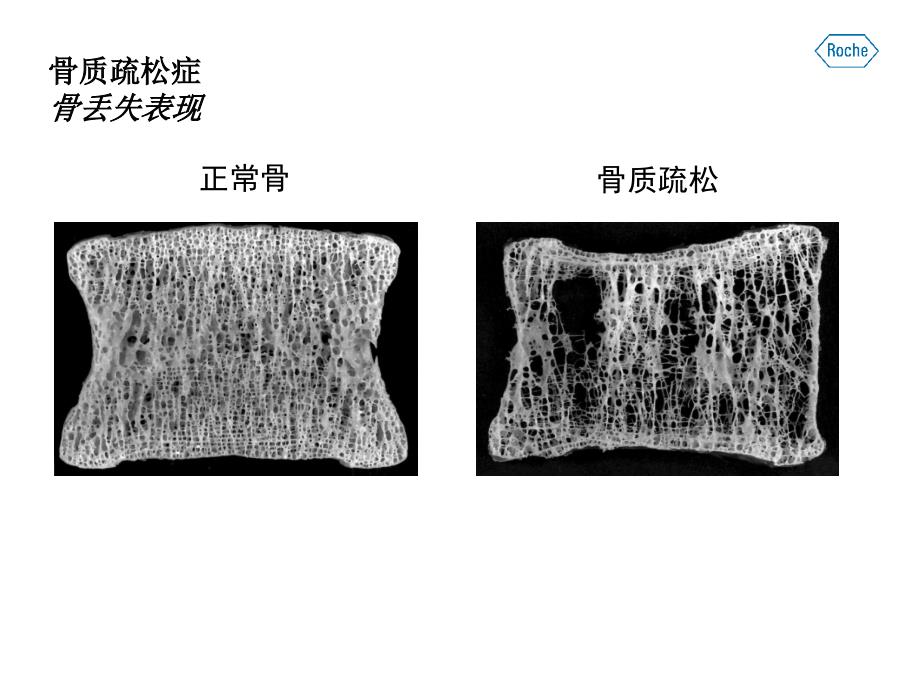 罗氏诊断骨标志物临床应用.ppt_第4页