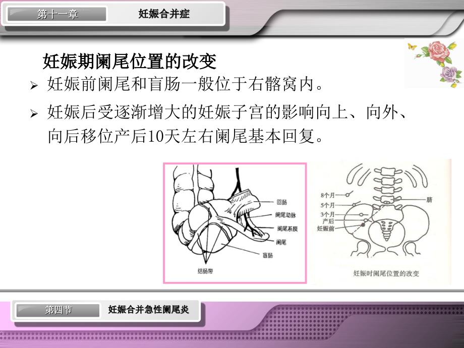 第十章妊娠合并阑尾炎.ppt_第4页