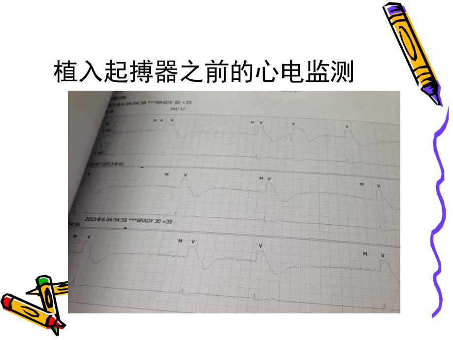 起搏器护理查房.ppt_第3页