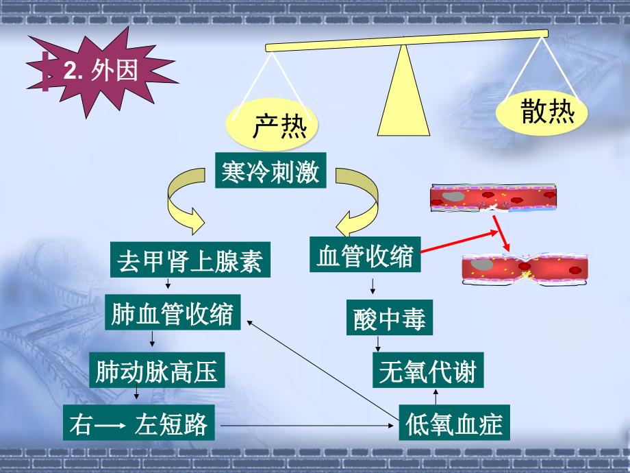 新生儿硬肿症-(2).ppt_第4页