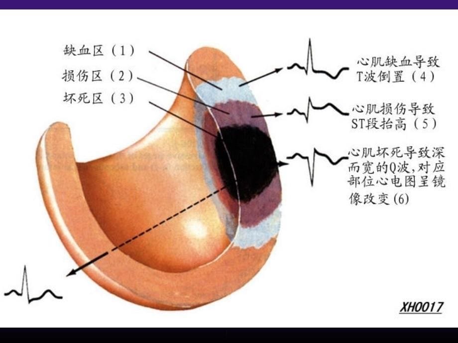 心肌梗死的课件ppt.ppt_第5页