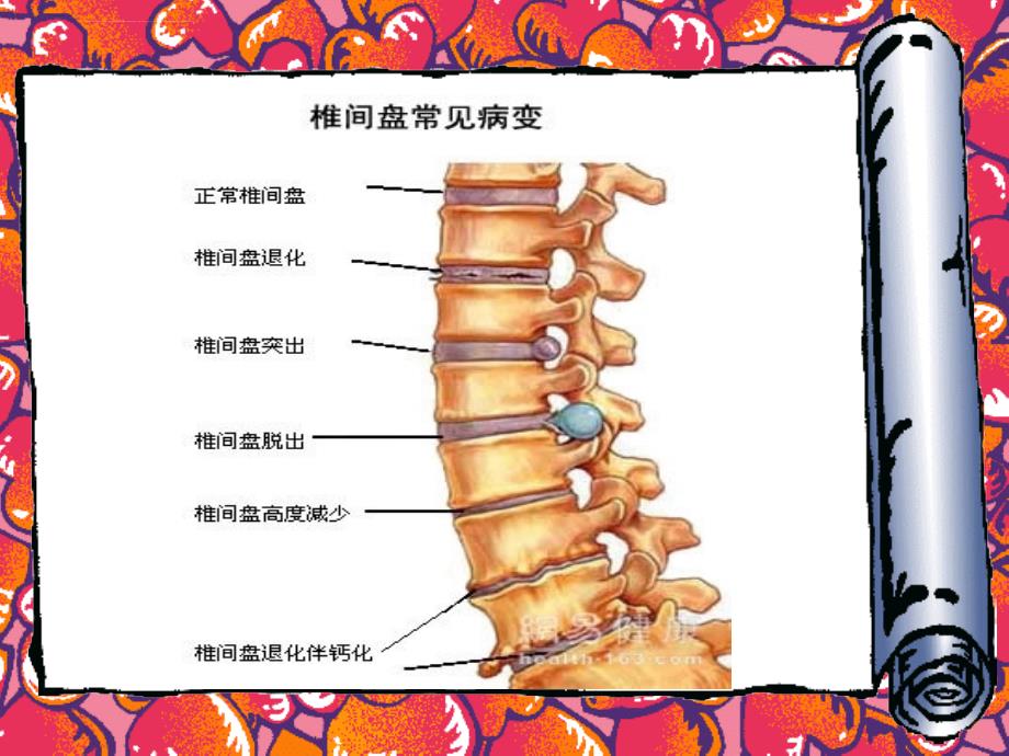 颈椎病的护理查房-元明.ppt_第3页