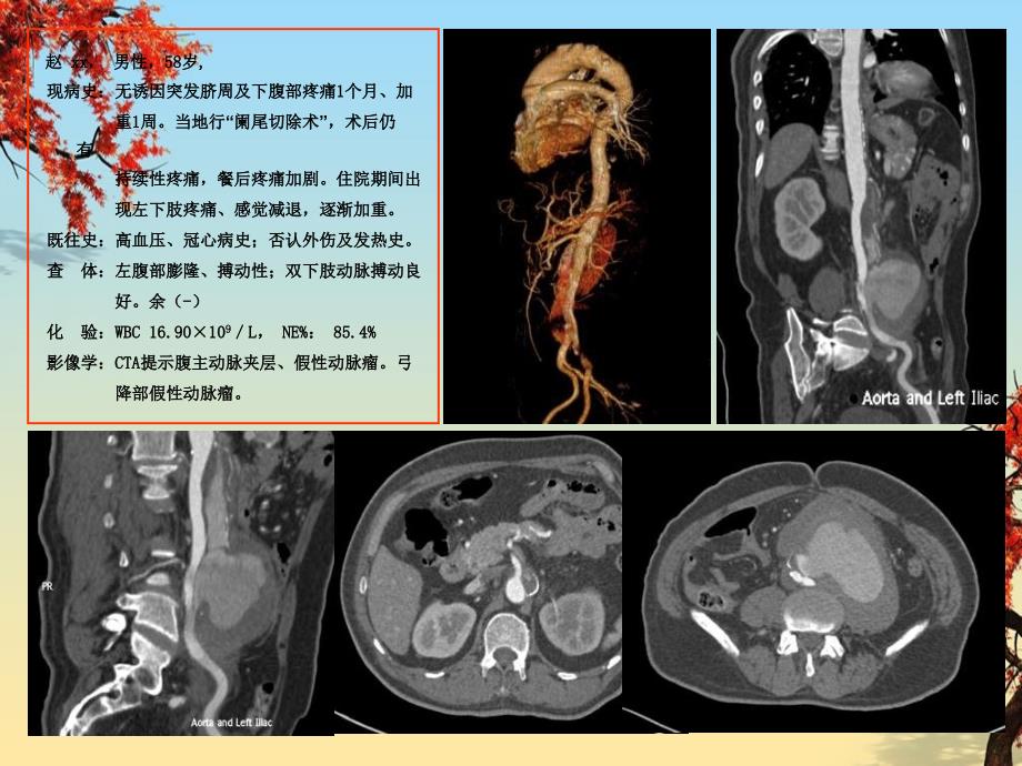 特殊动脉瘤腔内治疗策略病例分享_第2页