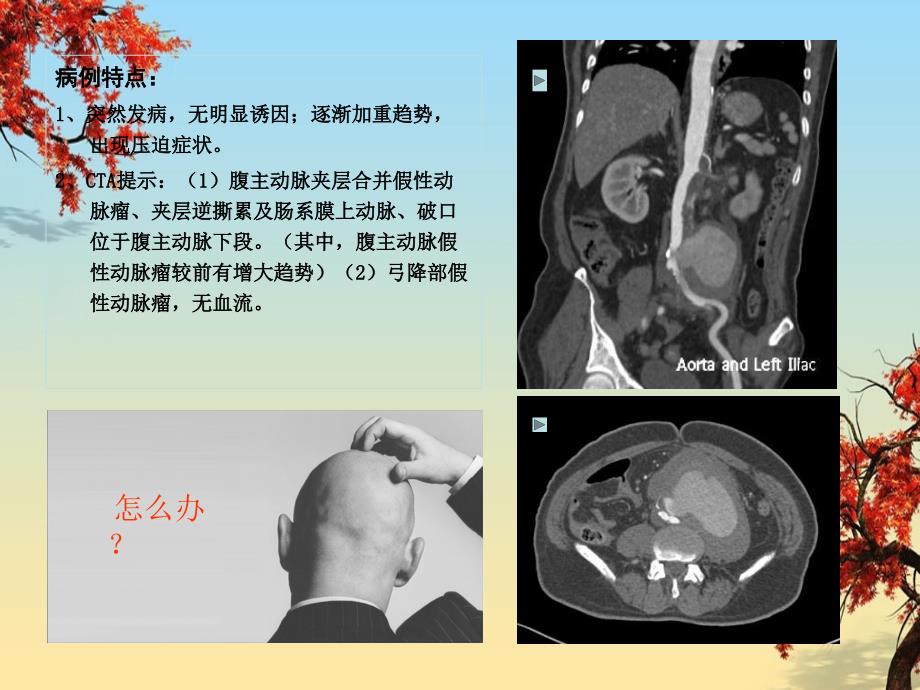 特殊动脉瘤腔内治疗策略病例分享_第3页