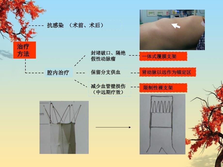 特殊动脉瘤腔内治疗策略病例分享_第5页