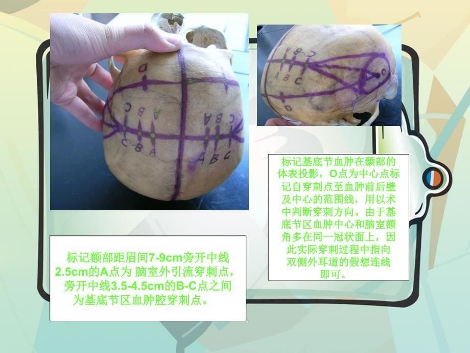 脑室引流管的护理.ppt_2_第5页