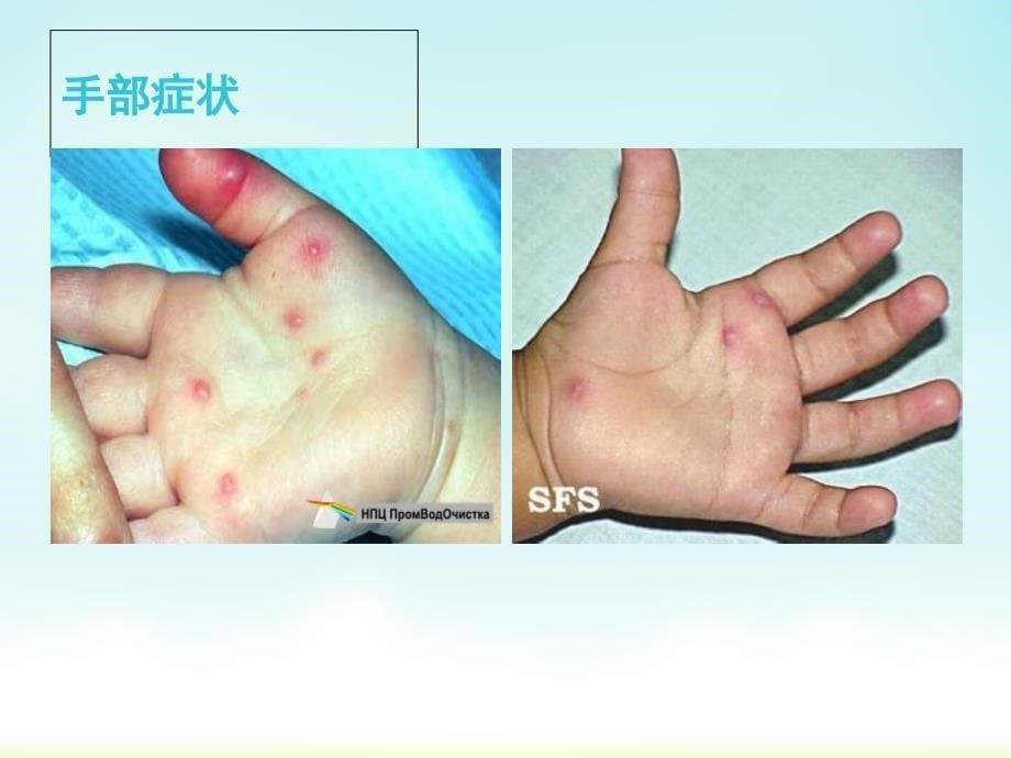 幼儿园健康教育：手足口病的预防.ppt_第5页