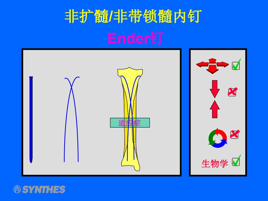 髓内钉_第1页