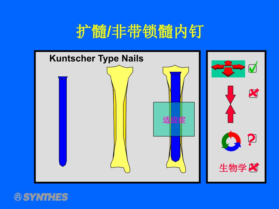 髓内钉_第2页