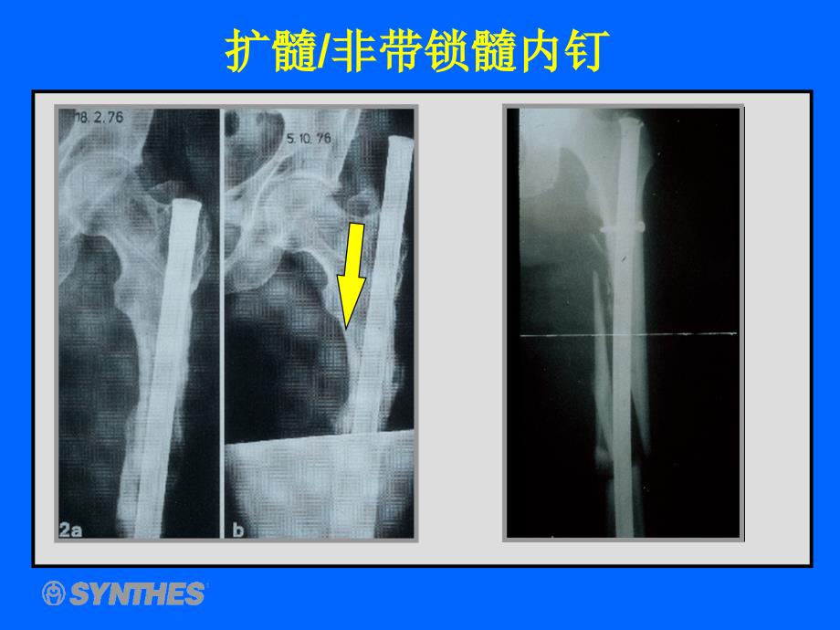 髓内钉_第4页