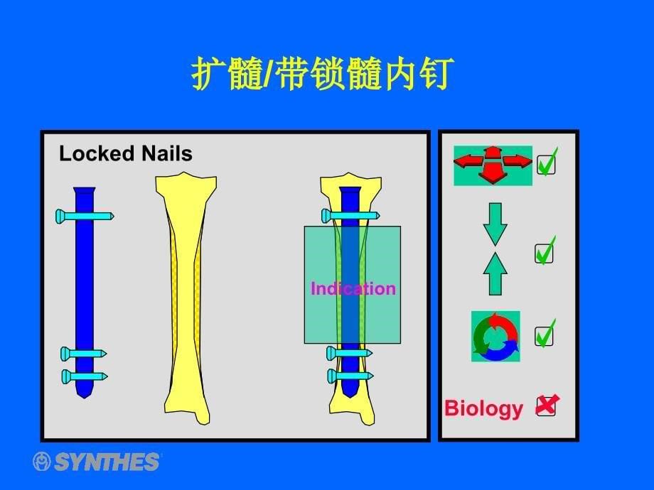 髓内钉_第5页