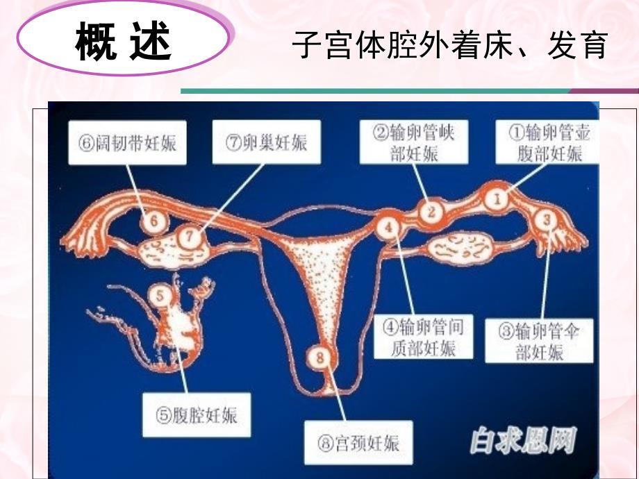 2017年2月业务学习异位妊娠的护理PPT课件_第3页