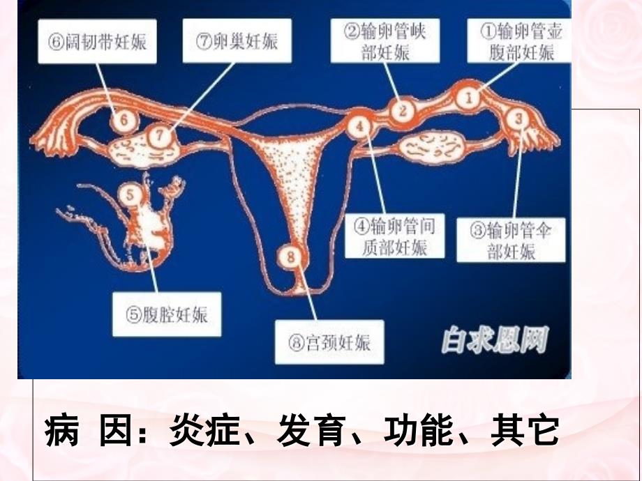 2017年2月业务学习异位妊娠的护理PPT课件_第4页