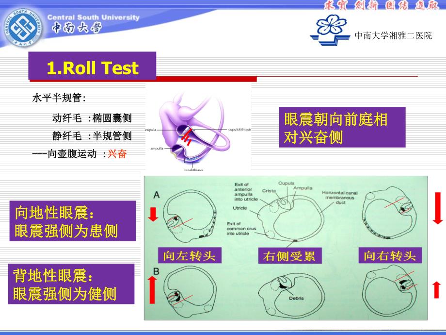 定侧困难的水平半规管BPPV复位资料_第4页