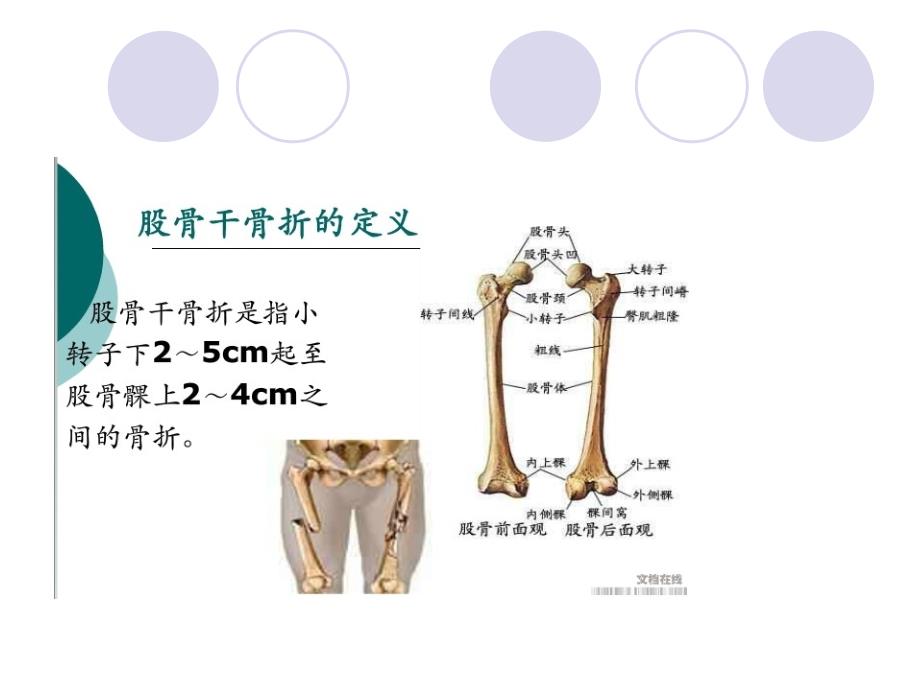 股骨干骨折护理查ppt课件_第4页