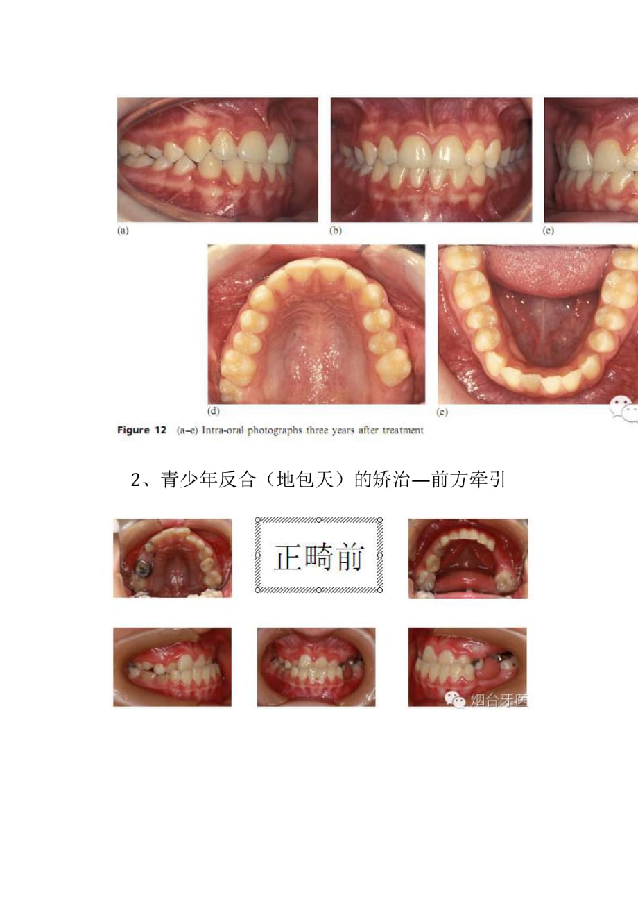 反合地包天的常用矫治方法_第3页