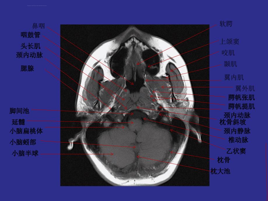 鼻咽部详细MRI断层图谱.ppt_第2页