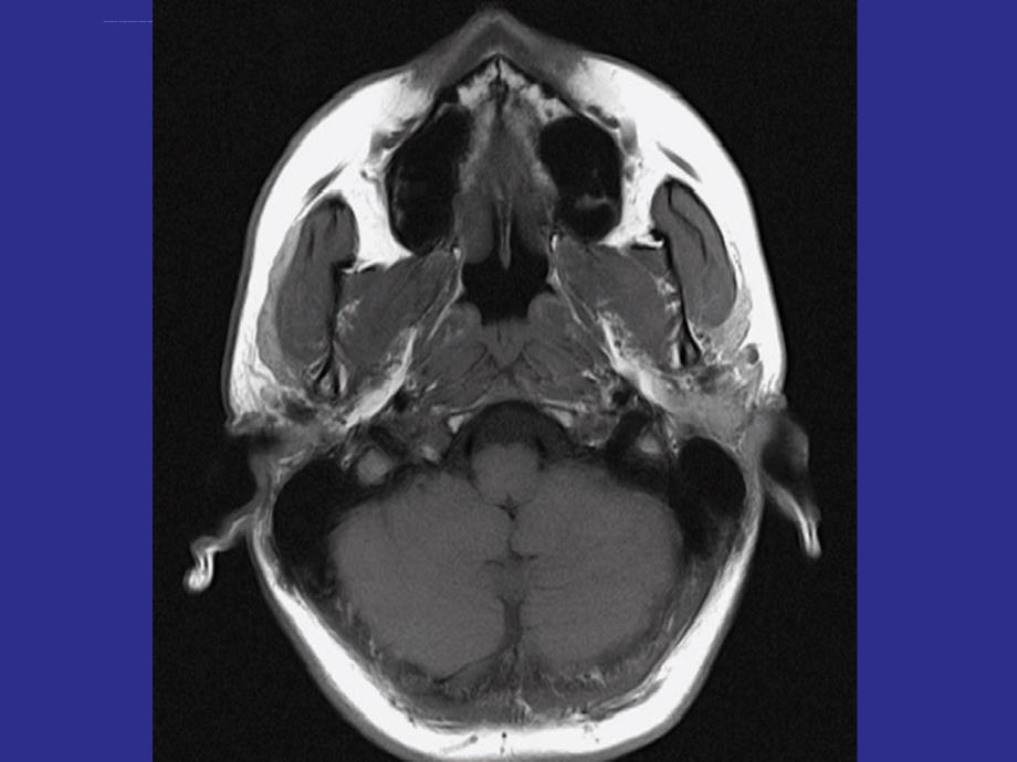 鼻咽部详细MRI断层图谱.ppt_第4页