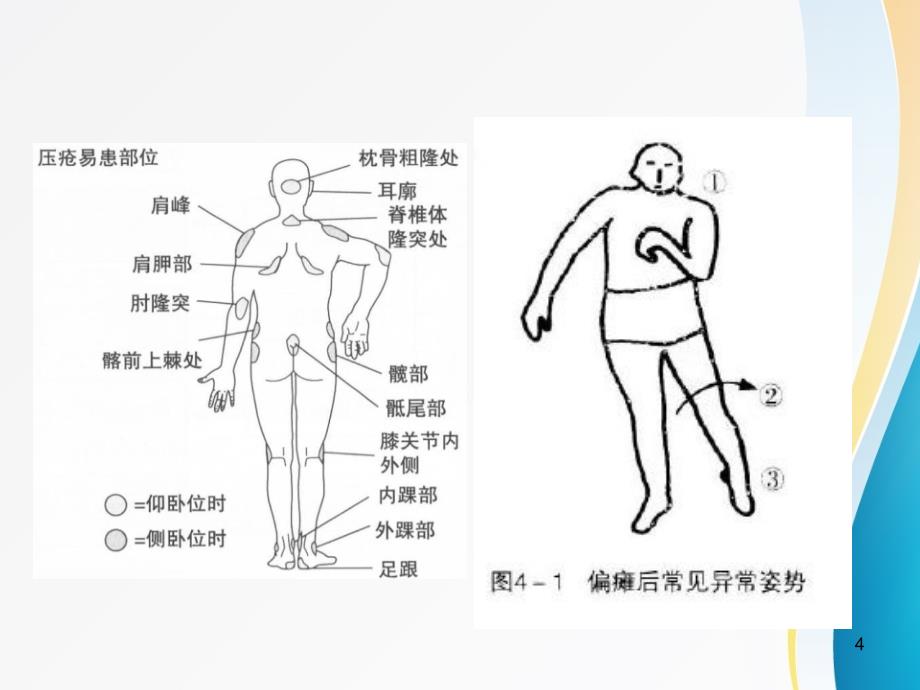 偏瘫的良肢位摆放与日常转移_第4页