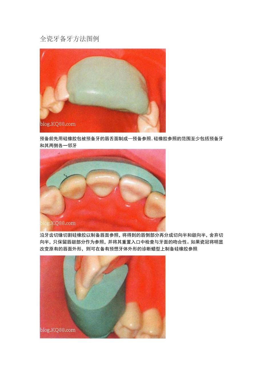 全瓷牙备牙方法图例资料_第1页