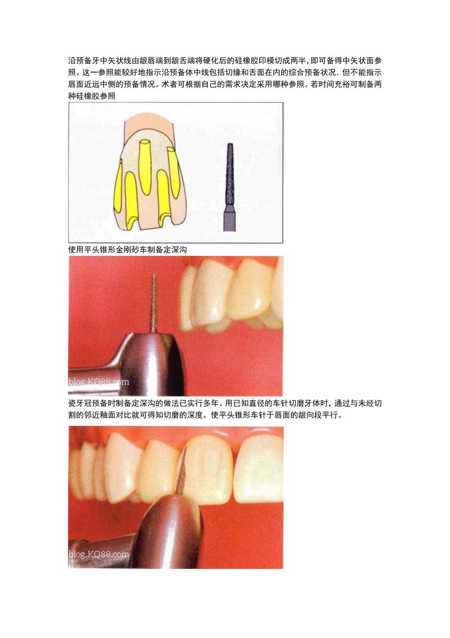 全瓷牙备牙方法图例资料_第2页