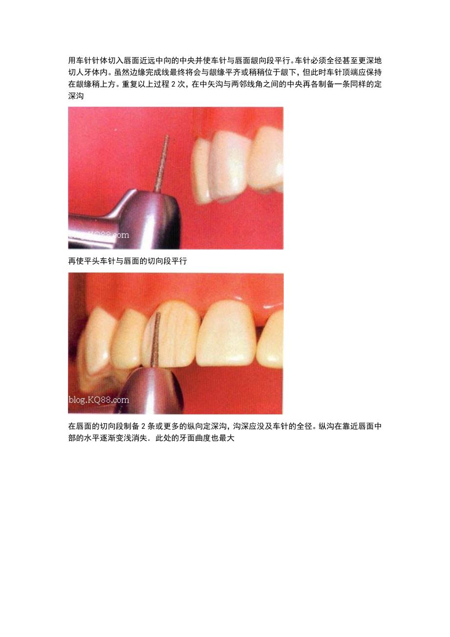 全瓷牙备牙方法图例资料_第3页