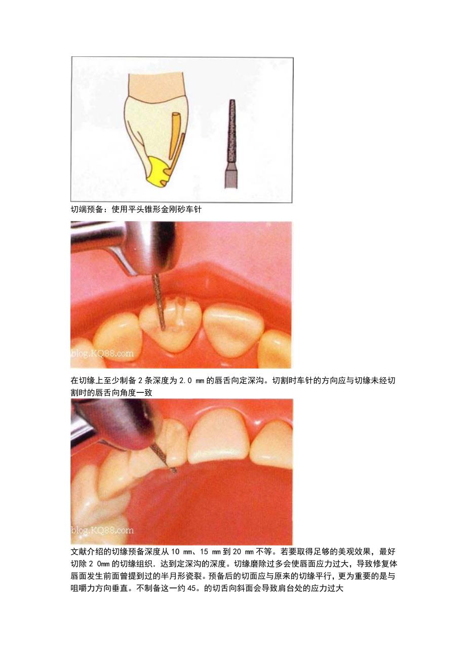 全瓷牙备牙方法图例资料_第4页