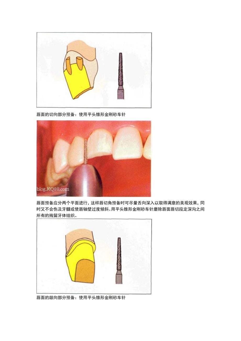 全瓷牙备牙方法图例资料_第5页