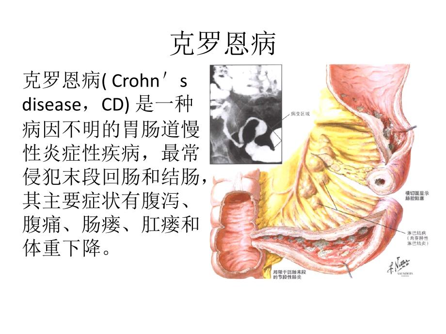 英夫利昔单抗在ibd中的应用资料_第2页