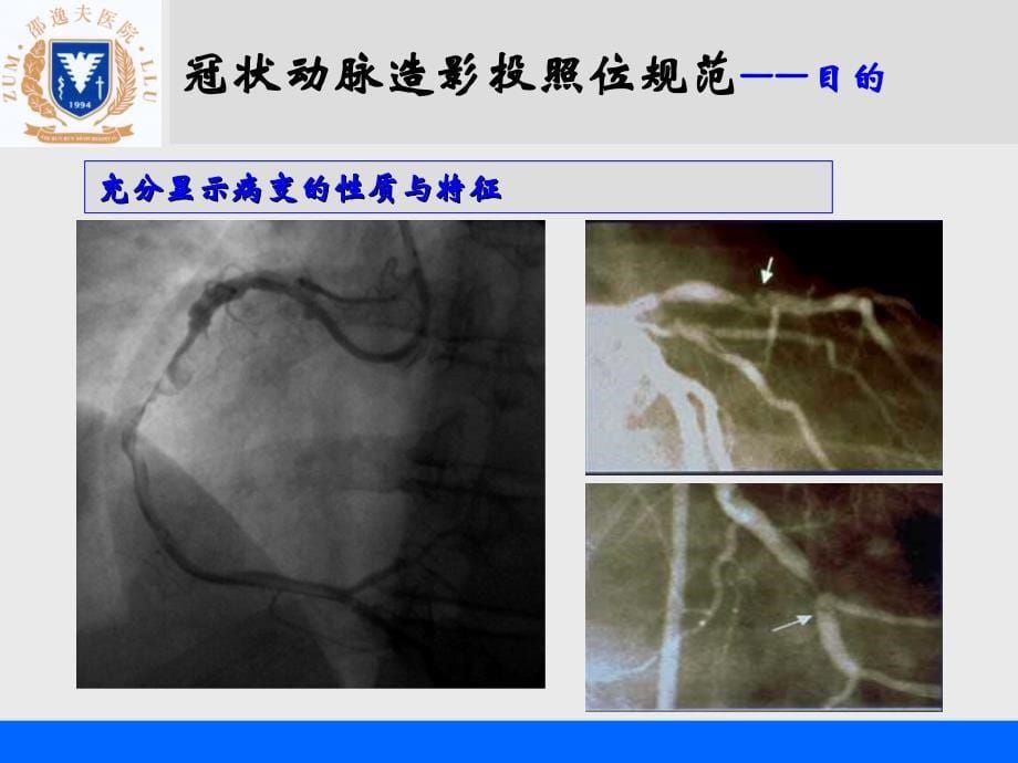 冠状动脉造影投照位规范与选择_第5页
