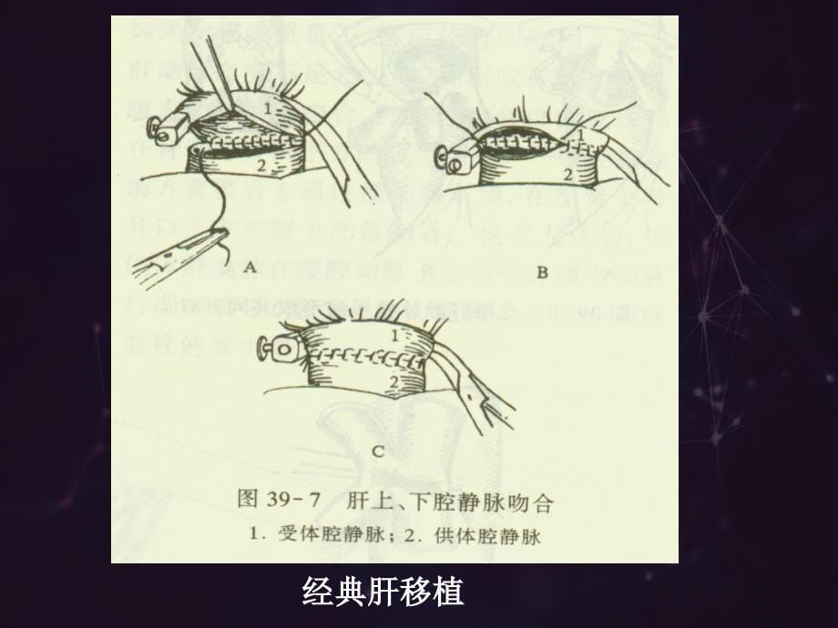 肝移植手术麻醉与围术期管理_北京肝病医院_第5页